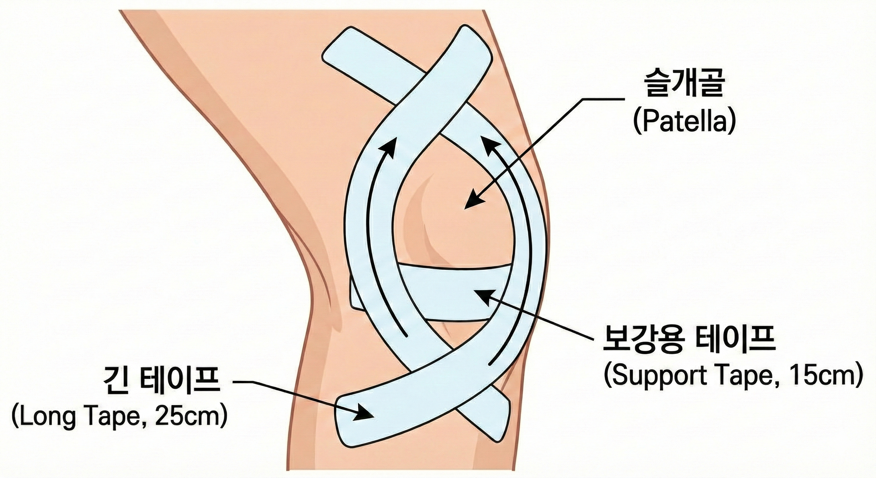 무릎 앞쪽 통증 (슬개골 부위/러너스 니)